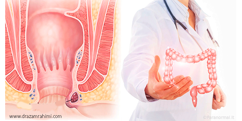 بهترین دکتر بواسیر