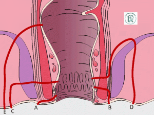 قیمت جراحی آبسه مقعدی