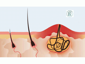 عوارض جراحی نکردن کیست مویی