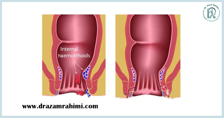 علائم کیست مویی